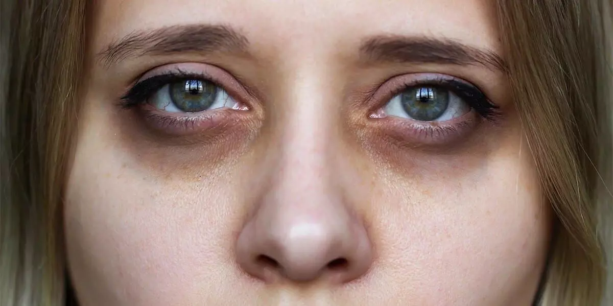 Dark Circles Under Your Eyes: కంటి కింద నల్లటి వలయాలు వేధిస్తున్నాయా? ఈ సింపుల్ ఇంటి చిట్కాలతో చెక్ పెట్టండి.. Dark Circles Under Your Eyes: కంటి కింద నల్లటి వలయాలు వేధిస్తున్నాయా? ఈ సింపుల్ ఇంటి చిట్కాలతో చెక్ పెట్టండి..