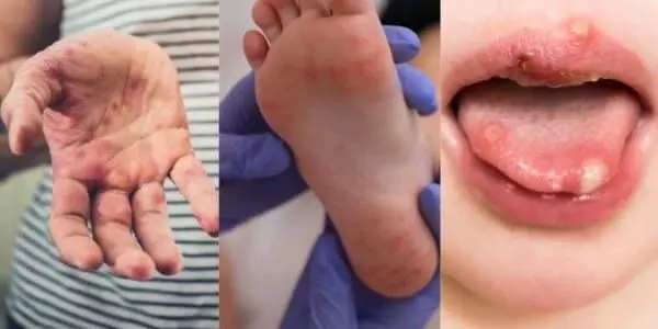 Hand, Foot and Mouth Disease: పిల్లల్లో పెరుగుతున్న హ్యాండ్, ఫుట్ అండ్ మౌత్ వ్యాధి...నిపుణుల సలహాలు ఇవే.. Hand, Foot and Mouth Disease: పిల్లల్లో పెరుగుతున్న హ్యాండ్, ఫుట్ అండ్ మౌత్ వ్యాధి...నిపుణుల సలహాలు ఇవే..
