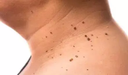 Troubled by Skin Warts: చర్మంపై పులిపిర్లతో బాధపడుతున్నారా? వాటికి గల కారణాలు, ఇంట్లోనే తగ్గించుకునే చిట్కాలు ఇవే.. Troubled by Skin Warts: చర్మంపై పులిపిర్లతో బాధపడుతున్నారా? వాటికి గల కారణాలు, ఇంట్లోనే తగ్గించుకునే చిట్కాలు ఇవే..