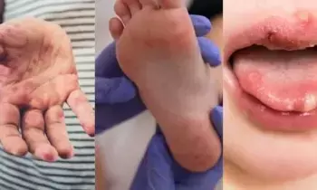 Hand, Foot and Mouth Disease: పిల్లల్లో పెరుగుతున్న హ్యాండ్, ఫుట్ అండ్ మౌత్ వ్యాధి...నిపుణుల సలహాలు ఇవే.. Hand, Foot and Mouth Disease: పిల్లల్లో పెరుగుతున్న హ్యాండ్, ఫుట్ అండ్ మౌత్ వ్యాధి...నిపుణుల సలహాలు ఇవే..