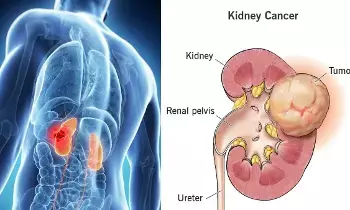 Blood in Urine: మూత్రంలో రక్తం పడుతుందా? కిడ్నీ క్యాన్సర్ లక్షణం కావచ్చు! Blood in Urine: మూత్రంలో రక్తం పడుతుందా? కిడ్నీ క్యాన్సర్ లక్షణం కావచ్చు!