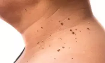 Troubled by Skin Warts: చర్మంపై పులిపిర్లతో బాధపడుతున్నారా? వాటికి గల కారణాలు, ఇంట్లోనే తగ్గించుకునే చిట్కాలు ఇవే.. Troubled by Skin Warts: చర్మంపై పులిపిర్లతో బాధపడుతున్నారా? వాటికి గల కారణాలు, ఇంట్లోనే తగ్గించుకునే చిట్కాలు ఇవే..