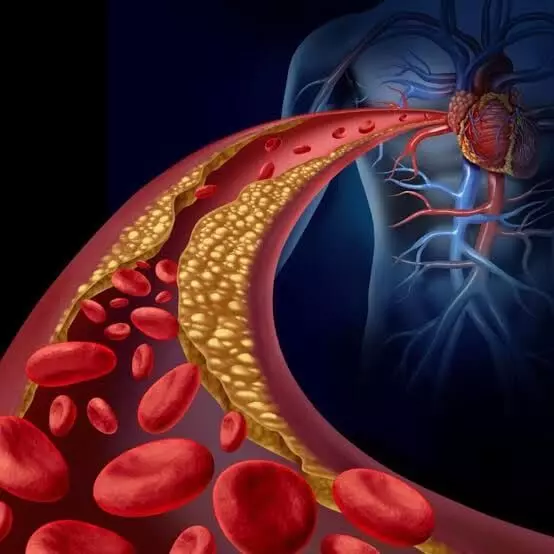 Growing Cholesterol Crisis: భారత్లో తీవ్రమవుతున్న కొలెస్ట్రాల్ సంక్షోభం.. ప్రతి 10 మందిలో తొమ్మిది మందికి అసాధారణ లిపిడ్ స్థాయిలు – ICMR షాకింగ్ సర్వే.. Growing Cholesterol Crisis: భారత్లో తీవ్రమవుతున్న కొలెస్ట్రాల్ సంక్షోభం.. ప్రతి 10 మందిలో తొమ్మిది మందికి అసాధారణ లిపిడ్ స్థాయిలు – ICMR షాకింగ్ సర్వే..
