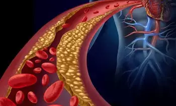 Growing Cholesterol Crisis: భారత్లో తీవ్రమవుతున్న కొలెస్ట్రాల్ సంక్షోభం.. ప్రతి 10 మందిలో తొమ్మిది మందికి అసాధారణ లిపిడ్ స్థాయిలు – ICMR షాకింగ్ సర్వే.. Growing Cholesterol Crisis: భారత్లో తీవ్రమవుతున్న కొలెస్ట్రాల్ సంక్షోభం.. ప్రతి 10 మందిలో తొమ్మిది మందికి అసాధారణ లిపిడ్ స్థాయిలు – ICMR షాకింగ్ సర్వే..