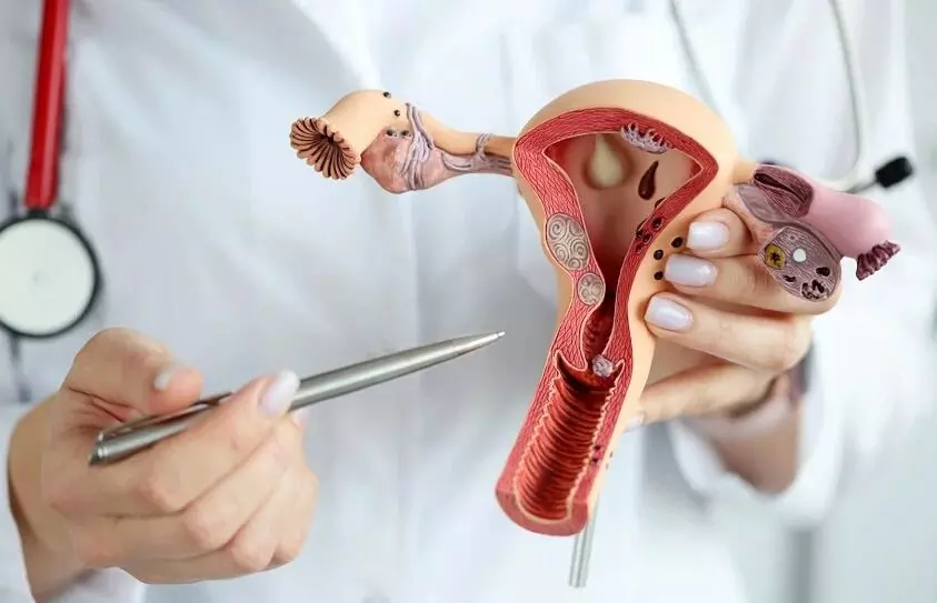 Endometriosis: ఎండోమెట్రియోసిస్కు శస్త్రచికిత్స అక్కర్లేదు.. సైంటిస్ట్ల సంచలనాత్మక పరిశోధన Endometriosis: ఎండోమెట్రియోసిస్కు శస్త్రచికిత్స అక్కర్లేదు.. సైంటిస్ట్ల సంచలనాత్మక పరిశోధన