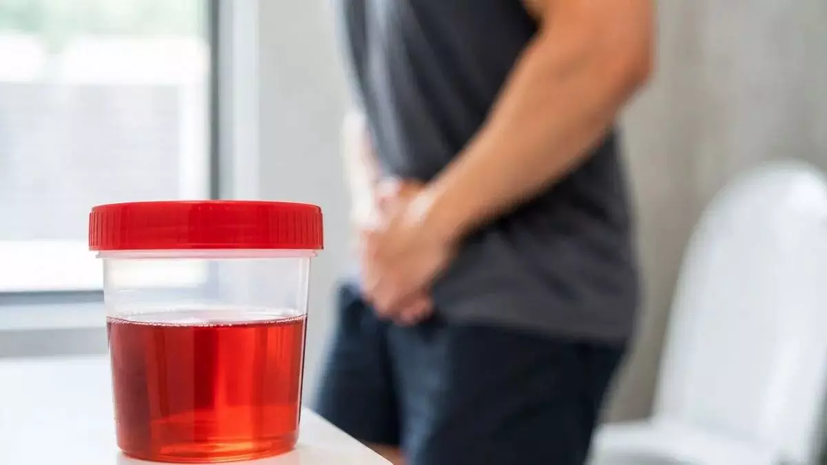 Seeing Blood in Your Urine After a Workout: వర్కౌట్ చేశాక మూత్రంలో రక్తం పడుతోందా? Seeing Blood in Your Urine After a Workout: వర్కౌట్ చేశాక మూత్రంలో రక్తం పడుతోందా?