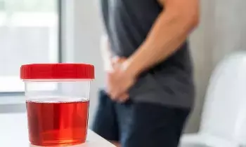 Seeing Blood in Your Urine After a Workout: వర్కౌట్ చేశాక మూత్రంలో రక్తం పడుతోందా? Seeing Blood in Your Urine After a Workout: వర్కౌట్ చేశాక మూత్రంలో రక్తం పడుతోందా?