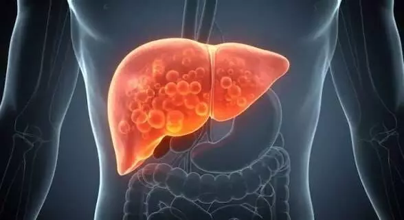 Fatty Liver: రాత్రి పూట తిండి మానేస్తే ఫ్యాటీ లివర్ తగ్గుతుందా? నిపుణులు ఏమంటున్నారంటే... Fatty Liver: రాత్రి పూట తిండి మానేస్తే ఫ్యాటీ లివర్ తగ్గుతుందా? నిపుణులు ఏమంటున్నారంటే...