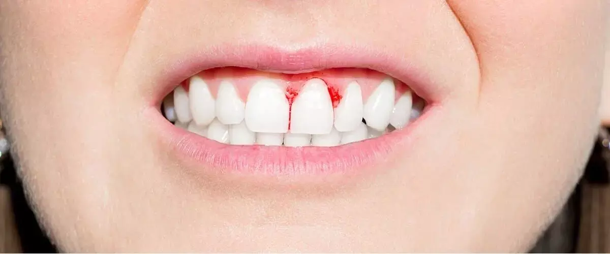 Bleeding Gums: దంతాల నుండి రక్తం వస్తోందా? నిర్లక్ష్యం చేస్తే పళ్లు ఊడిపోయే ప్రమాదం.. Bleeding Gums: దంతాల నుండి రక్తం వస్తోందా? నిర్లక్ష్యం చేస్తే పళ్లు ఊడిపోయే ప్రమాదం..