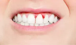 Bleeding Gums: దంతాల నుండి రక్తం వస్తోందా? నిర్లక్ష్యం చేస్తే పళ్లు ఊడిపోయే ప్రమాదం..