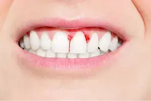 Bleeding Gums: దంతాల నుండి రక్తం వస్తోందా? నిర్లక్ష్యం చేస్తే పళ్లు ఊడిపోయే ప్రమాదం.. Bleeding Gums: దంతాల నుండి రక్తం వస్తోందా? నిర్లక్ష్యం చేస్తే పళ్లు ఊడిపోయే ప్రమాదం..