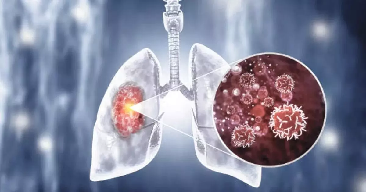 Lung Cancer Without Smoking: స్మోకింగ్ చేయకపోయినా ఊపిరితిత్తుల క్యాన్సర్.. భారత్లో షాకింగ్ నిజాలు Lung Cancer Without Smoking: స్మోకింగ్ చేయకపోయినా ఊపిరితిత్తుల క్యాన్సర్.. భారత్లో షాకింగ్ నిజాలు