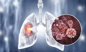 Lung Cancer Without Smoking: స్మోకింగ్ చేయకపోయినా ఊపిరితిత్తుల క్యాన్సర్.. భారత్లో షాకింగ్ నిజాలు Lung Cancer Without Smoking: స్మోకింగ్ చేయకపోయినా ఊపిరితిత్తుల క్యాన్సర్.. భారత్లో షాకింగ్ నిజాలు