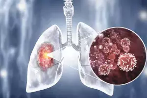 Lung Cancer Without Smoking: స్మోకింగ్ చేయకపోయినా ఊపిరితిత్తుల క్యాన్సర్.. భారత్లో షాకింగ్ నిజాలు Lung Cancer Without Smoking: స్మోకింగ్ చేయకపోయినా ఊపిరితిత్తుల క్యాన్సర్.. భారత్లో షాకింగ్ నిజాలు