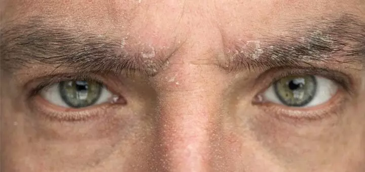 Troubled by Eyebrow Dandruff: కనుబొమ్మల్లో చుండ్రుతో ఇబ్బంది పడుతున్నారా? ఈ సింపుల్ చిట్కాలతో చెక్ పెట్టండి! Troubled by Eyebrow Dandruff: కనుబొమ్మల్లో చుండ్రుతో ఇబ్బంది పడుతున్నారా? ఈ సింపుల్ చిట్కాలతో చెక్ పెట్టండి!