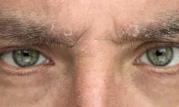 Troubled by Eyebrow Dandruff: కనుబొమ్మల్లో చుండ్రుతో ఇబ్బంది పడుతున్నారా? ఈ సింపుల్ చిట్కాలతో చెక్ పెట్టండి!