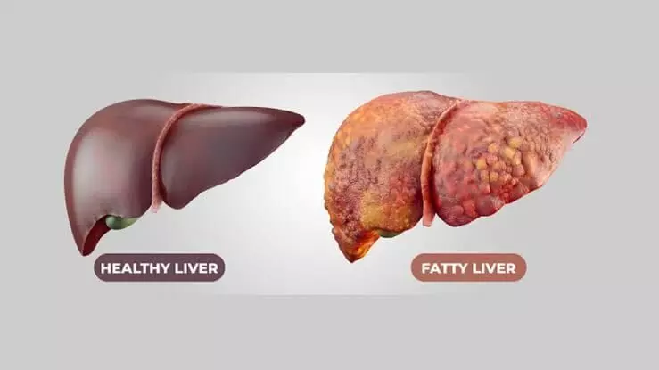 Fatty Liver: గుట్టుచప్పుడు కాకుండా దాడి చేసే ఫ్యాటీ లివర్.. బయటపడడానికి గోల్డెన్ రూల్స్ ఇవే.. Fatty Liver: గుట్టుచప్పుడు కాకుండా దాడి చేసే ఫ్యాటీ లివర్.. బయటపడడానికి గోల్డెన్ రూల్స్ ఇవే..