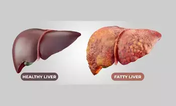 Fatty Liver:  గుట్టుచప్పుడు కాకుండా దాడి చేసే ఫ్యాటీ లివర్.. బయటపడడానికి గోల్డెన్ రూల్స్ ఇవే..