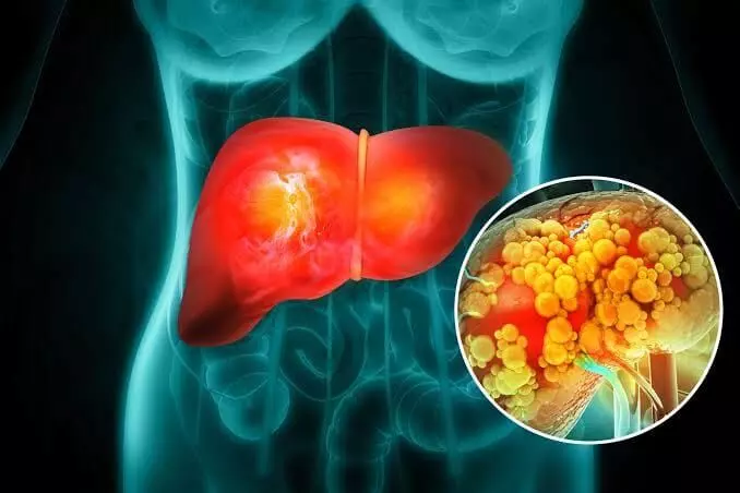 Fatty Liver: భారతదేశాన్ని ముంచెత్తుతున్న ఫ్యాటీ లివర్ సంక్షోభం.. 12 కోట్ల మందికి పైగా ముప్పు.. Fatty Liver: భారతదేశాన్ని ముంచెత్తుతున్న ఫ్యాటీ లివర్ సంక్షోభం.. 12 కోట్ల మందికి పైగా ముప్పు..