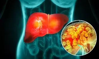 Fatty Liver: భారతదేశాన్ని ముంచెత్తుతున్న ఫ్యాటీ లివర్ సంక్షోభం.. 12 కోట్ల మందికి పైగా ముప్పు..