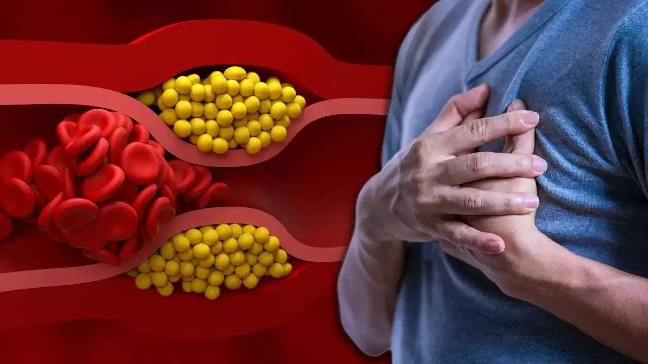 Bad Cholesterol: సైలెంట్ కిల్లర్ చెడు కొలెస్ట్రాల్.. గుండెపోటు ముప్పు పెంచే రోజువారీ అలవాట్లు ఇవే Bad Cholesterol: సైలెంట్ కిల్లర్ చెడు కొలెస్ట్రాల్.. గుండెపోటు ముప్పు పెంచే రోజువారీ అలవాట్లు ఇవే
