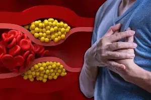 Bad Cholesterol:  సైలెంట్ కిల్లర్ చెడు కొలెస్ట్రాల్.. గుండెపోటు ముప్పు పెంచే రోజువారీ అలవాట్లు ఇవే