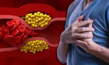 Bad Cholesterol:  సైలెంట్ కిల్లర్ చెడు కొలెస్ట్రాల్.. గుండెపోటు ముప్పు పెంచే రోజువారీ అలవాట్లు ఇవే