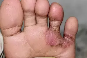 Fungal Infections: వర్షాకాలంలో కాళ్లకు ఫంగల్ ఇన్ఫెక్షన్లు వేధిస్తున్నాయా? ఈ తప్పులు అస్సలు చేయకండి.. Fungal Infections: వర్షాకాలంలో కాళ్లకు ఫంగల్ ఇన్ఫెక్షన్లు వేధిస్తున్నాయా? ఈ తప్పులు అస్సలు చేయకండి..