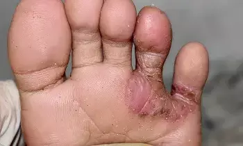 Fungal Infections: వర్షాకాలంలో కాళ్లకు ఫంగల్ ఇన్ఫెక్షన్లు వేధిస్తున్నాయా? ఈ  తప్పులు అస్సలు చేయకండి..