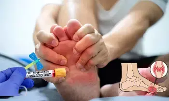 High Uric Acid: శరీరంలో యూరిక్ యాసిడ్ పెరిగిందా? ఏ పండ్లు తినాలి.. వేటికి దూరంగా ఉండాలి?