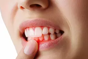 Bleeding Gums While Brushing: బ్రష్ చేసేటప్పుడు చిగుళ్ల నుంచి రక్తం వస్తోందా? Bleeding Gums While Brushing: బ్రష్ చేసేటప్పుడు చిగుళ్ల నుంచి రక్తం వస్తోందా?