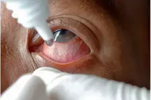 Eye Drops: కంటి చుక్కల మందు వాడుతున్నారా? సీల్ తెరిచిన తర్వాత నెలలు గడిస్తే కంటిచూపుకే ప్రమాదం Eye Drops: కంటి చుక్కల మందు వాడుతున్నారా? సీల్ తెరిచిన తర్వాత నెలలు గడిస్తే కంటిచూపుకే ప్రమాదం