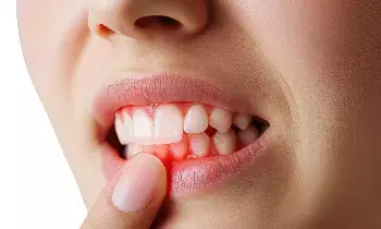 Bleeding Gums While Brushing: బ్రష్ చేసేటప్పుడు చిగుళ్ల నుంచి రక్తం వస్తోందా?