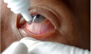 Eye Drops: కంటి చుక్కల మందు వాడుతున్నారా? సీల్ తెరిచిన తర్వాత నెలలు గడిస్తే కంటిచూపుకే ప్రమాదం
