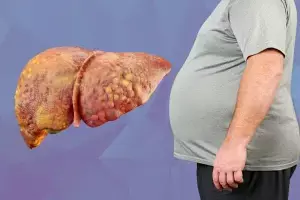 Suffering from Fatty Liver: ఫ్యాటీ లివర్తో బాధపడుతున్నారా? కంగారు పడకండి చేసుకునేందుకు వైద్యుల కీలక సూచనలు ఇవే.. Suffering from Fatty Liver: ఫ్యాటీ లివర్తో బాధపడుతున్నారా? కంగారు పడకండి చేసుకునేందుకు వైద్యుల కీలక సూచనలు ఇవే..