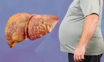 Suffering from Fatty Liver: ఫ్యాటీ లివర్‌తో బాధపడుతున్నారా? కంగారు పడకండి చేసుకునేందుకు వైద్యుల కీలక సూచనలు ఇవే..