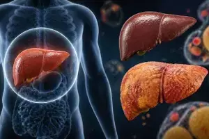 Ignore Fatty Liver and Face a Cancer Risk: నిర్లక్ష్యం చేస్తే క్యాన్సర్ ముప్పు.. ఫ్యాటీ లివర్ను సహజంగా ఎలా తగ్గించుకోవాలి? Ignore Fatty Liver and Face a Cancer Risk: నిర్లక్ష్యం చేస్తే క్యాన్సర్ ముప్పు.. ఫ్యాటీ లివర్ను సహజంగా ఎలా తగ్గించుకోవాలి?
