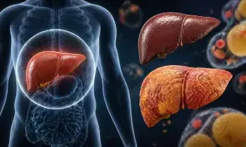 Ignore Fatty Liver and Face a Cancer Risk: నిర్లక్ష్యం చేస్తే క్యాన్సర్ ముప్పు.. ఫ్యాటీ లివర్ను సహజంగా ఎలా తగ్గించుకోవాలి? Ignore Fatty Liver and Face a Cancer Risk: నిర్లక్ష్యం చేస్తే క్యాన్సర్ ముప్పు.. ఫ్యాటీ లివర్ను సహజంగా ఎలా తగ్గించుకోవాలి?