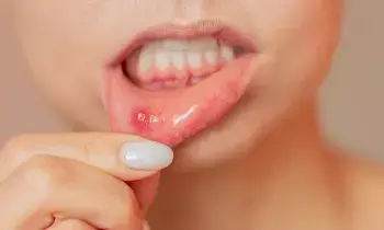 Suffering from Painful Mouth Ulcers: నోటి పూతతో నరకం చూస్తున్నారా? కారణాలు ఇవే.. నొప్పి తగ్గించుకోవడానికి 5 సహజ చిట్కాలు..