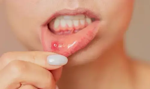 Suffering from Painful Mouth Ulcers: నోటి పూతతో నరకం చూస్తున్నారా? కారణాలు ఇవే.. నొప్పి తగ్గించుకోవడానికి 5 సహజ చిట్కాలు..