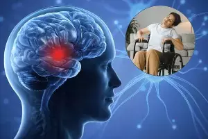 Rising Stroke Risk Among People Over 30: 30 దాటిన వారిలో పెరుగుతున్న పక్షవాతం ముప్పు.. యువతరం ఎందుకు జాగ్రత్తపడాలి? Rising Stroke Risk Among People Over 30: 30 దాటిన వారిలో పెరుగుతున్న పక్షవాతం ముప్పు.. యువతరం ఎందుకు జాగ్రత్తపడాలి?